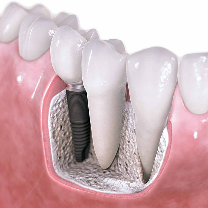 Dental Implants