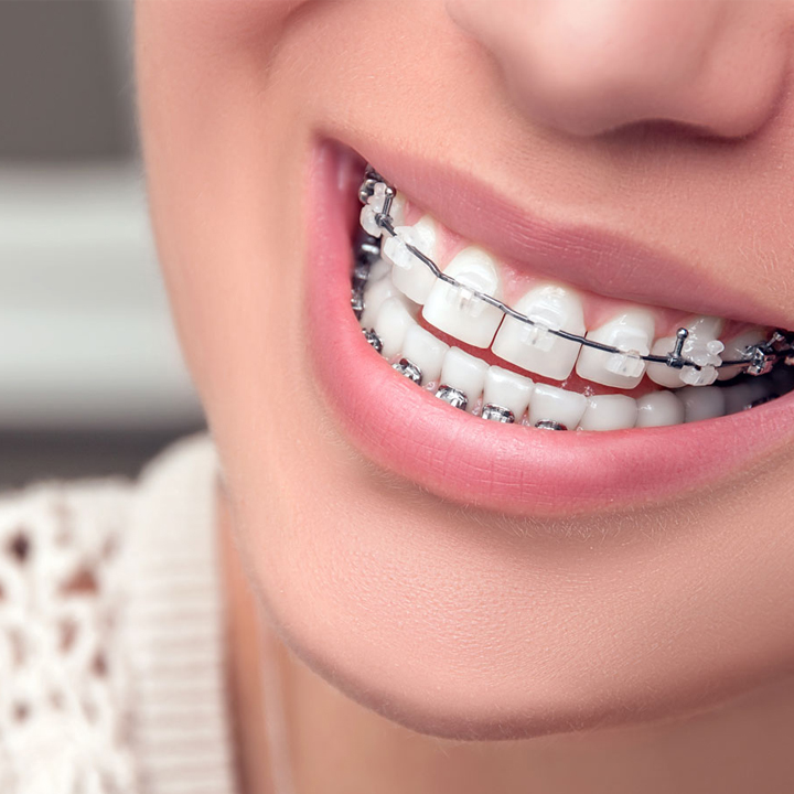 Orthodontic Braces & Aligners