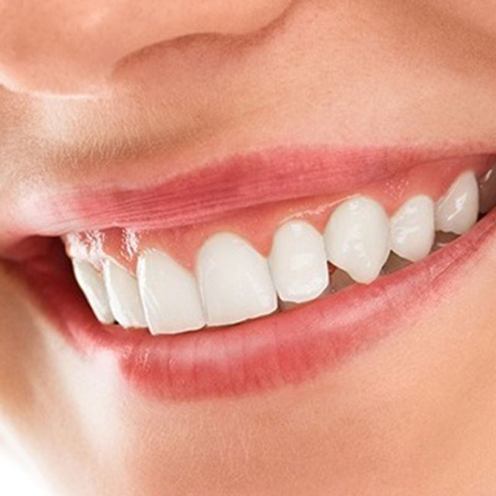 Smile Makeover