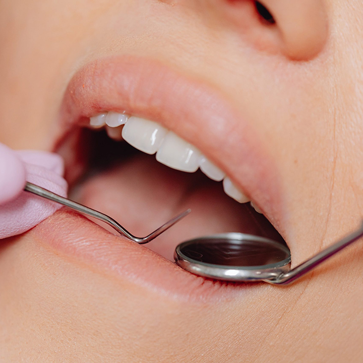 Teeth Cleaning