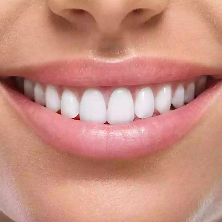 Veneers