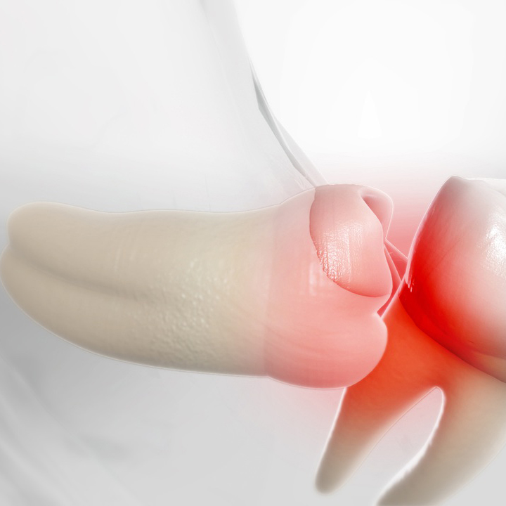 Wisdom Tooth Extraction