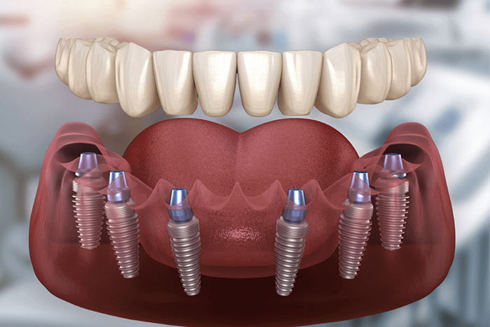 All-on-6 Dental Implants